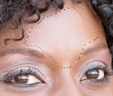 lasso forehead